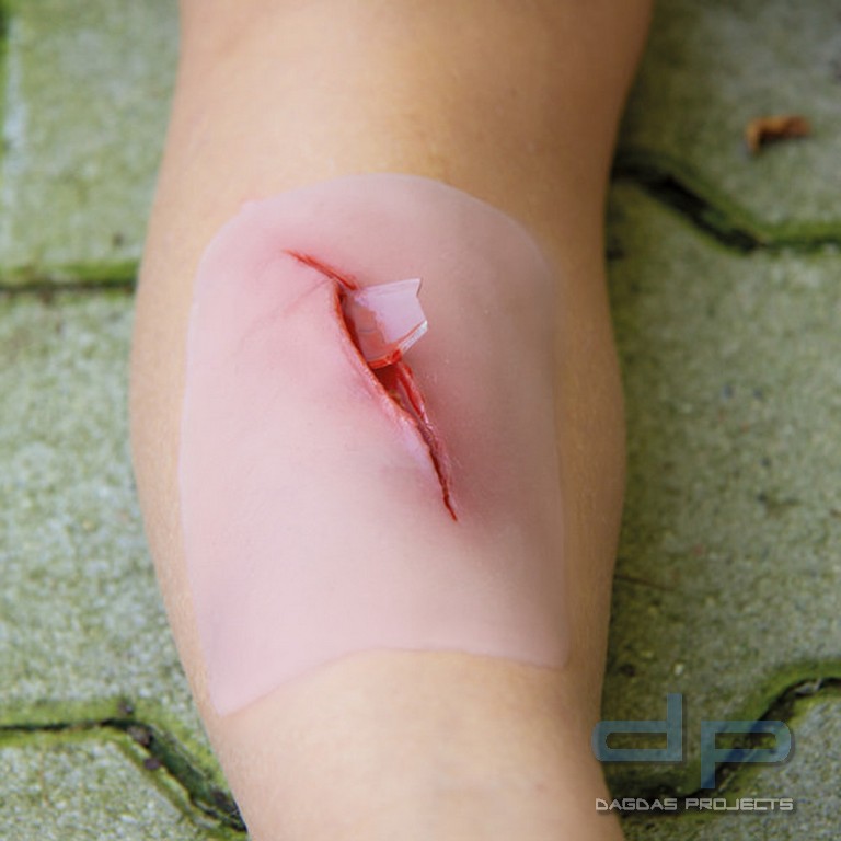 Wundmoulage Schnittwunde mit Glassplitter