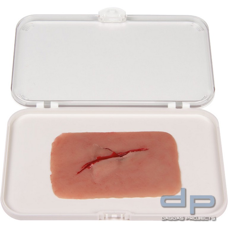 Wundmoulage Schnittwunde mit Glassplitter