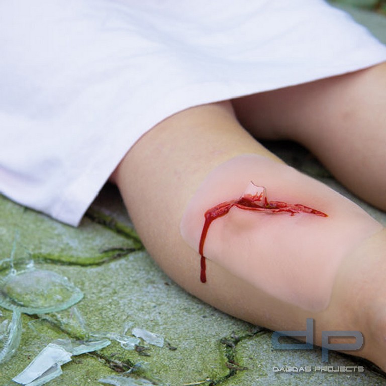 Wundmoulage Schnittwunde mit Glassplitter