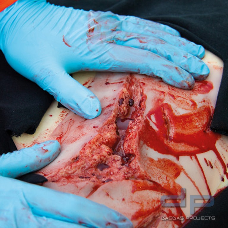 Wundmoulage Risswunde groß mit Blutungsfunktion