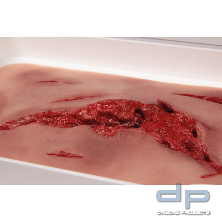 Wundmoulage Risswunde groß mit Blutungsfunktion
