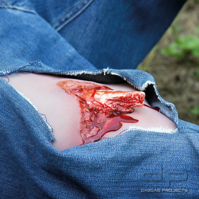 Wundmoulage Offener Beinbruch mit Blutungsfunktion