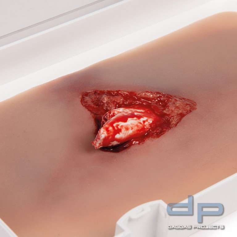 Wundmoulage Offener Beinbruch mit Blutungsfunktion