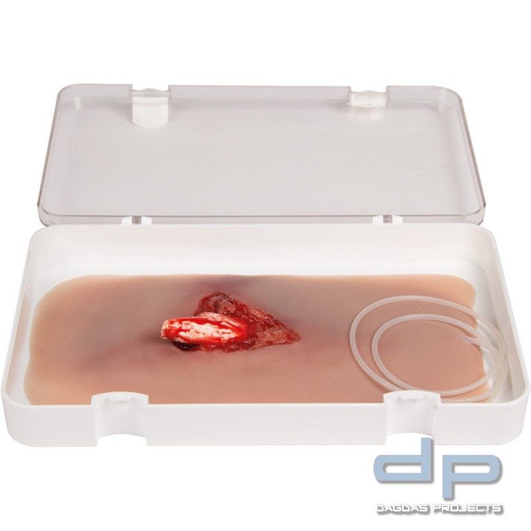 Wundmoulage Offener Beinbruch mit Blutungsfunktion